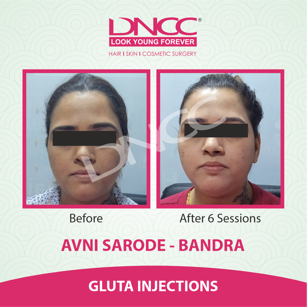 Hair Transplant Transformation 1